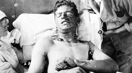 Ein durch Senfgas verletzter Mann